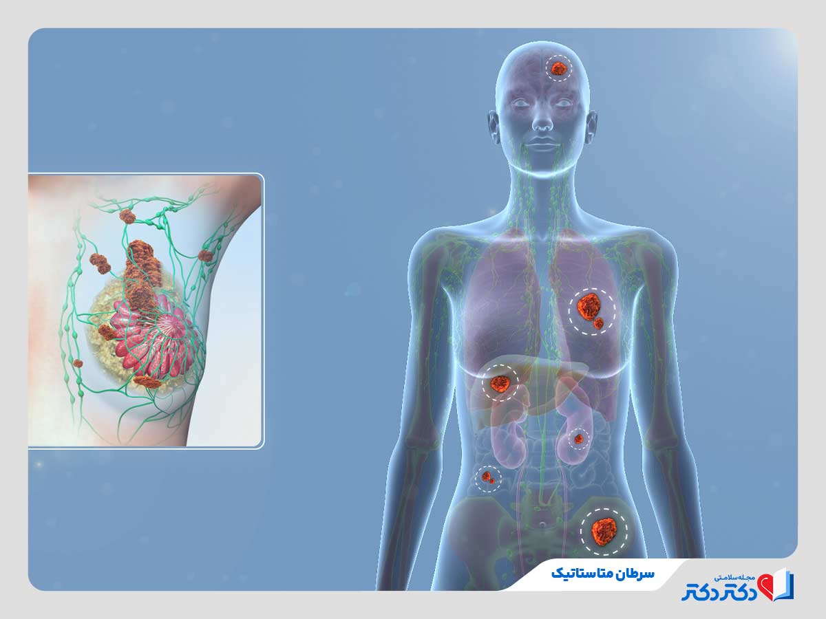 انتشار سرطان سینه به سایر اندام‌های بدن
