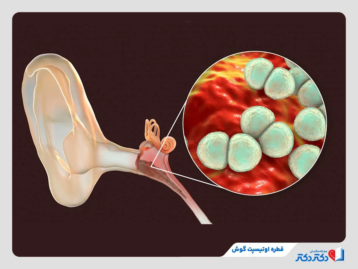 تصویر عفونت گوش خارجی که با قطره اوتیسپت قابل درمان است.