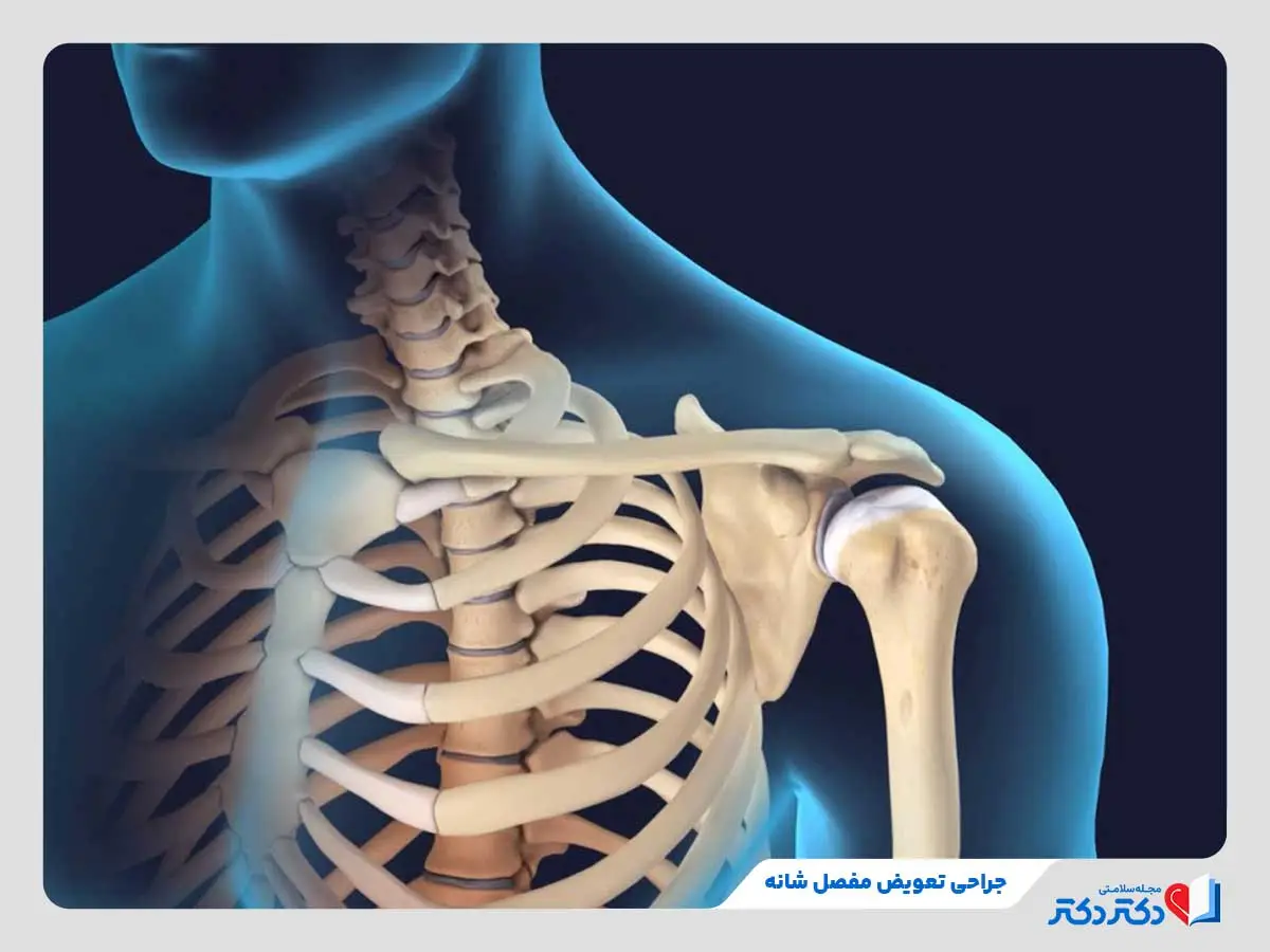 جراحی تعویض مفصل شانه برای برداشتن استخوان شانه که دچار ساییدگی یا شکستگی است.