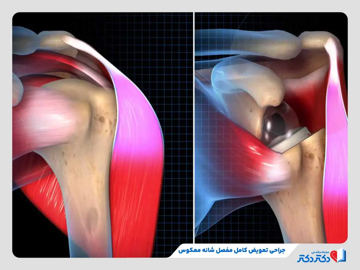 تصویر جراحی تعویض کامل مفصل شانه معکوس که جای گوی و حفره در مفصل شانه جابجا می‌شود.