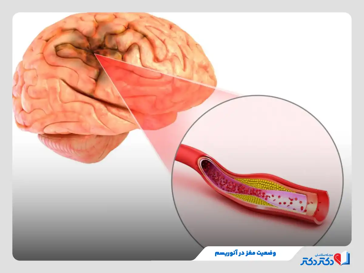 وضعیت رگ مغز در ابتلا به آنوریسم