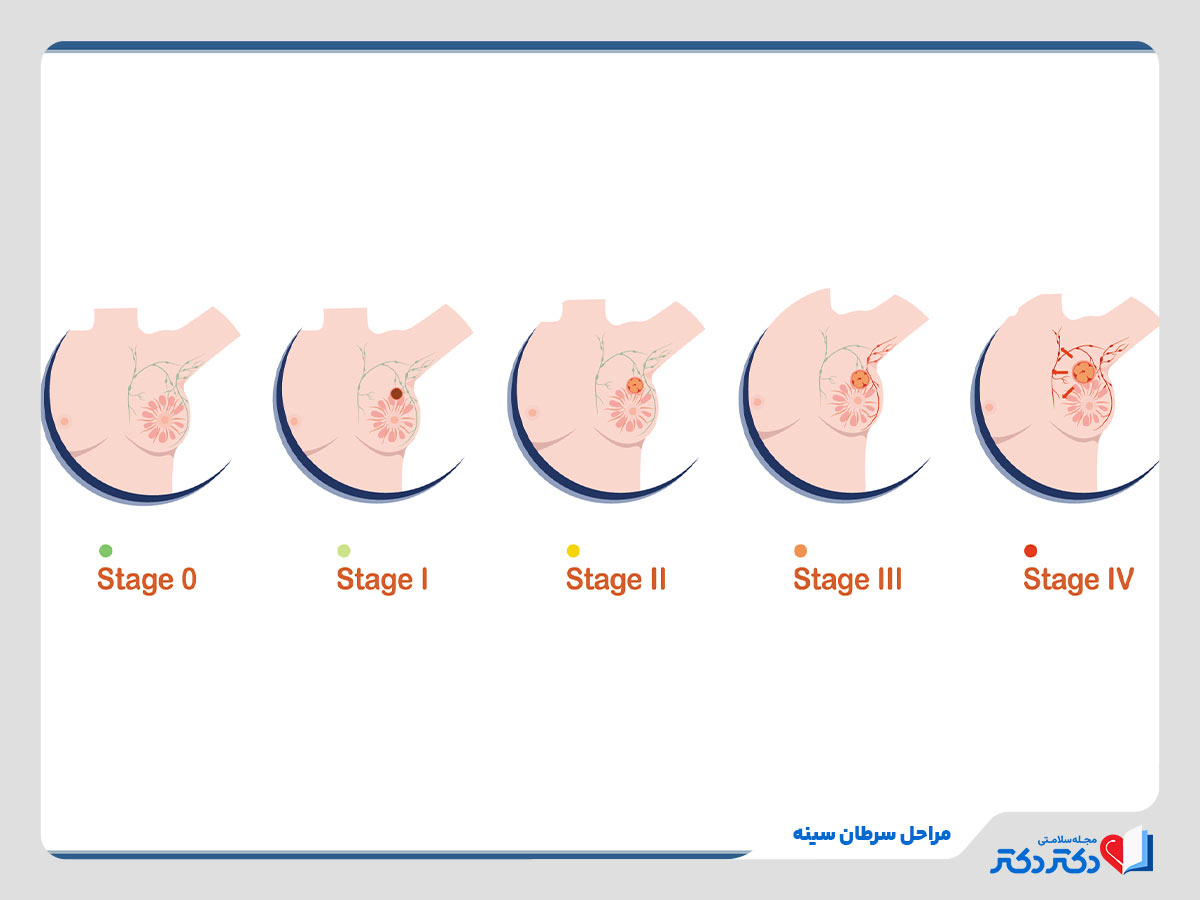 پنج مرحله پیشرفت سرطان سینه