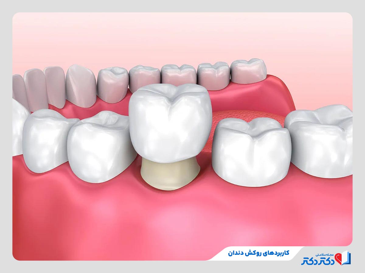 انجام روکش دندان در شرایط پوسیدگی دندان یا تغییر رنگ آن‌ها