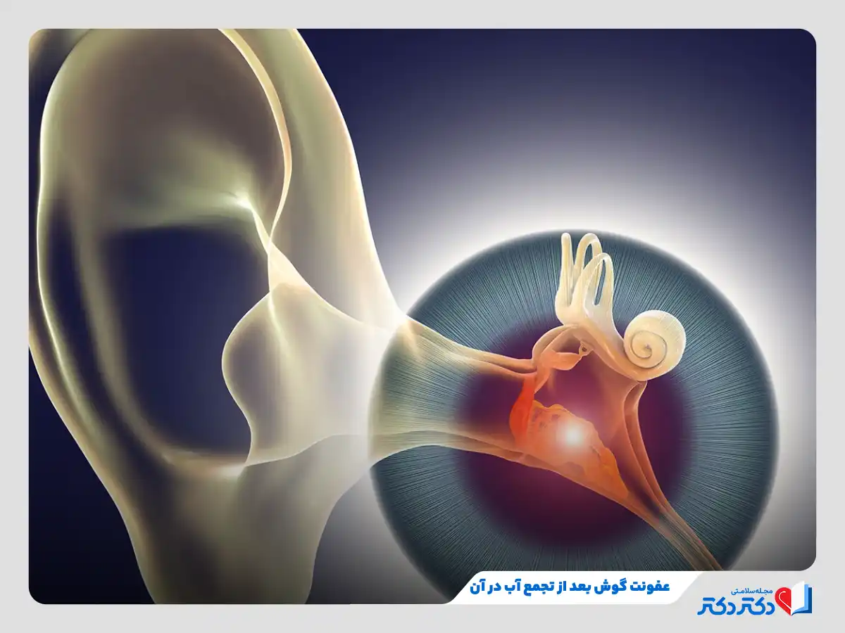 عفونت گوش به دلیل تجمع آب و ایجاد بستری برای رشد میکروب ها