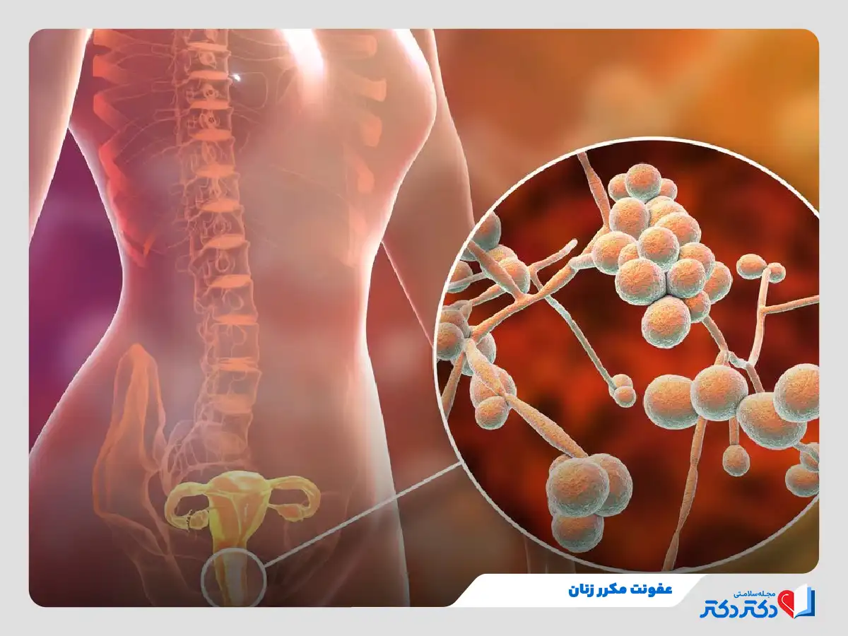 عفونت مکرر زنان و بازگشت بیماری دست کم در ۴ دوره در طول یک سال