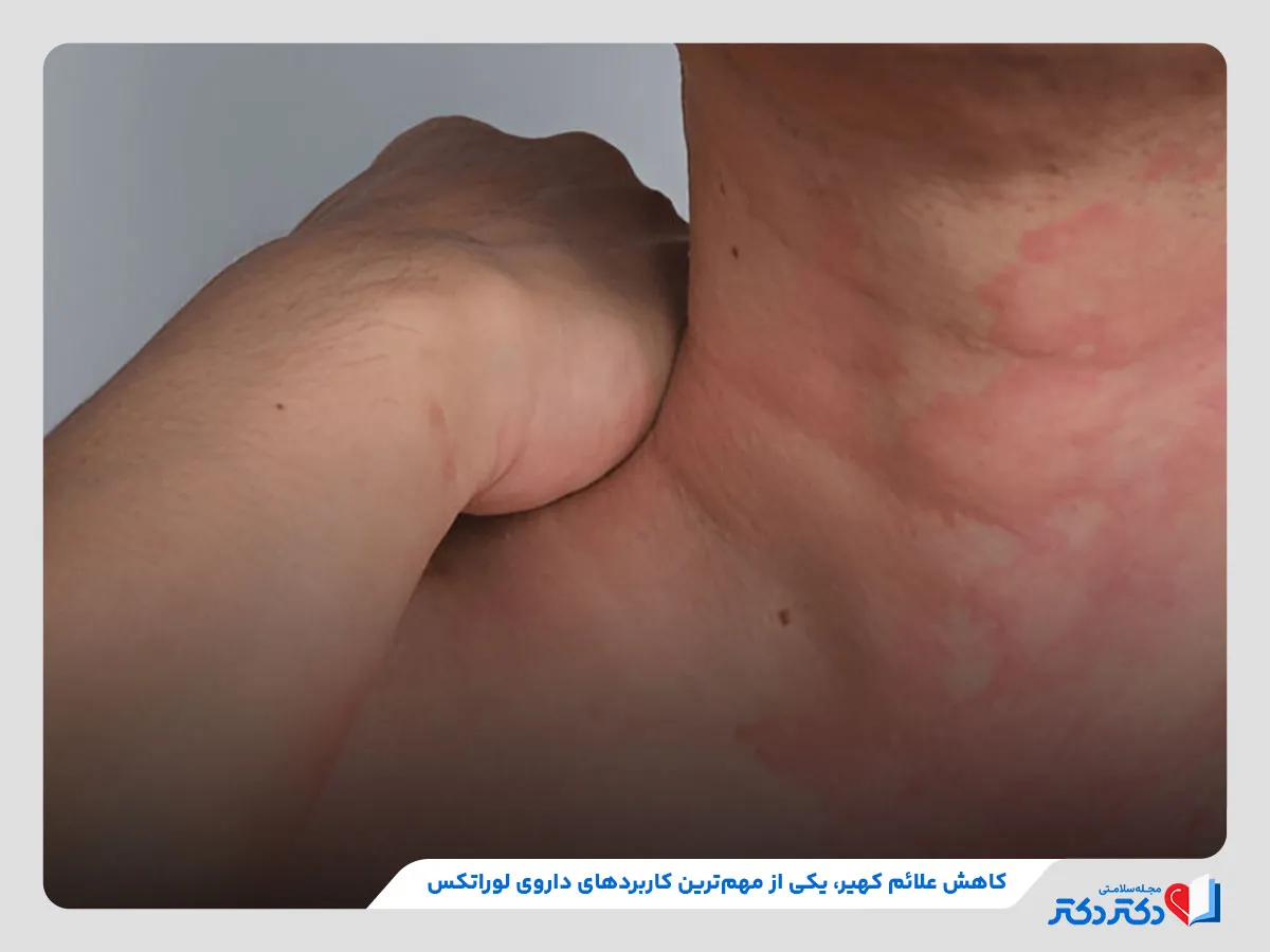 مصرف لوراتادین برای درمان علائم ناشی از کهیر