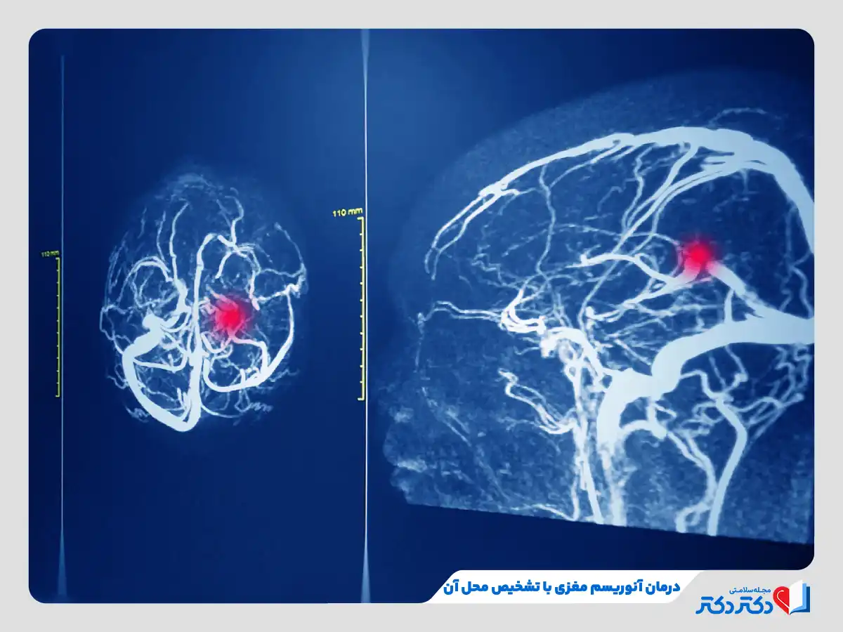 تشخیص آنوریسم مغزی با عکس‌برداری و درمان با روش‌های جراحی