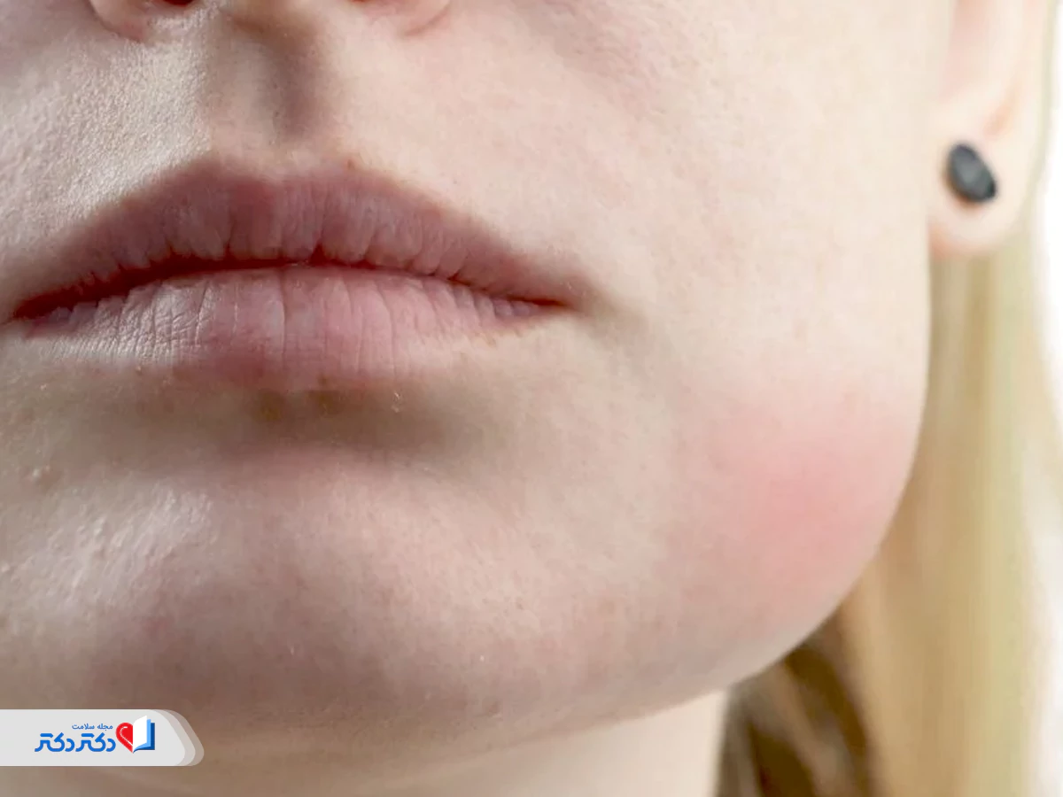 واکنش آلرژیک از عوارض قرص پاروکستین