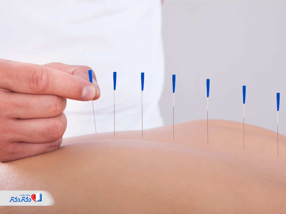طب سوزنی درمان جایگزین برای سندروم پیش از قاعدگی
