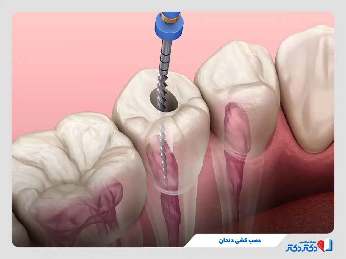 عصب کشی دندان و رفع عفونت و آسیب رگ و عصب