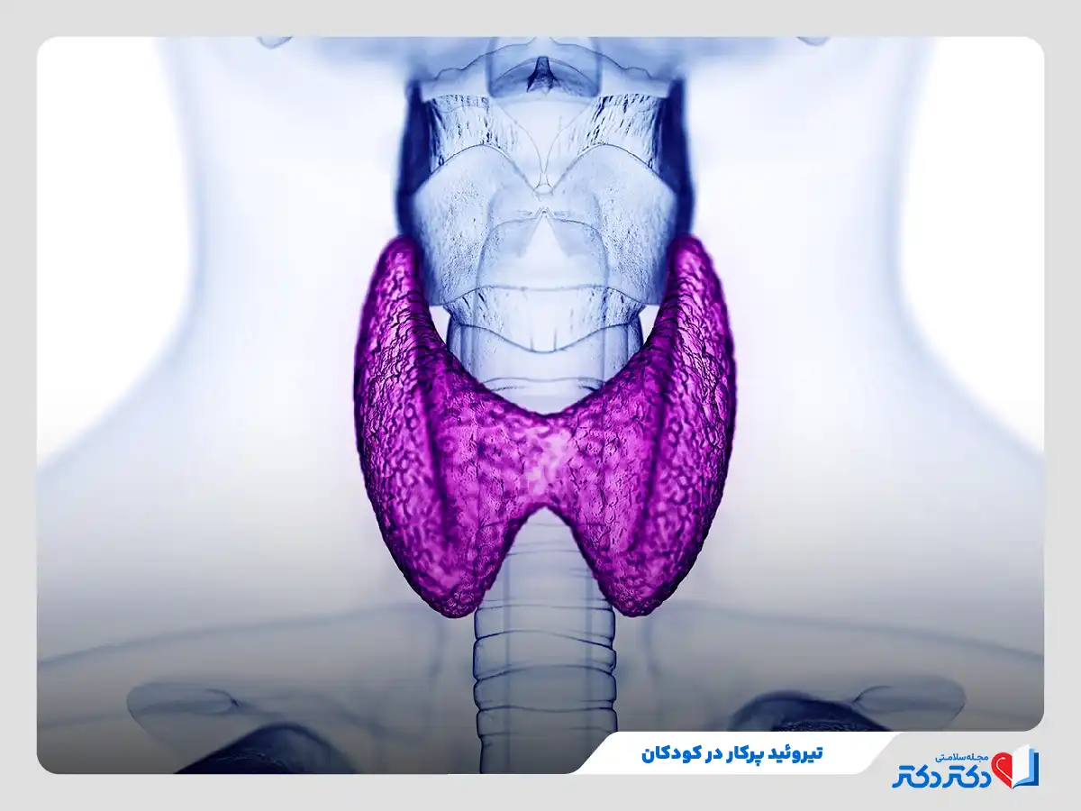 تصویر آزمایش سی تی اسکن تیروئید پرکار در کودکان