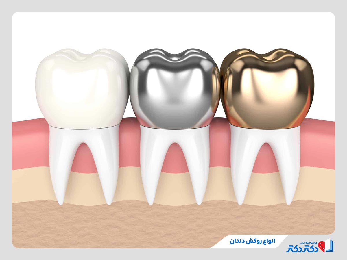 روکش تمام‌فلزی، سرامیکی و زیرکونیا از انواع روکش دندان