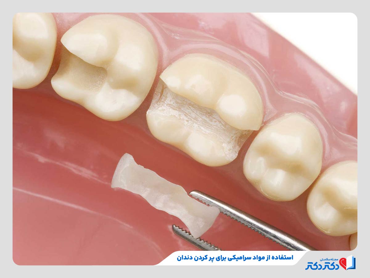 به کار گرفتن سرامیک برای پر کردن دندان