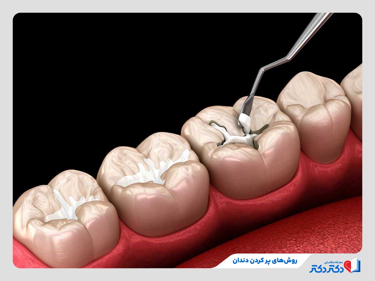 پر کردن دندان با انواع مواد پرکننده