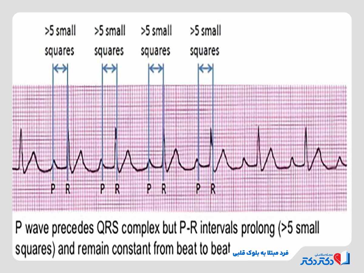 نتیجه تست نوار قلب نشاندهنده ابتلای فرد به بلوک قلبی یکی از اختلالات هدایتی قلبی 