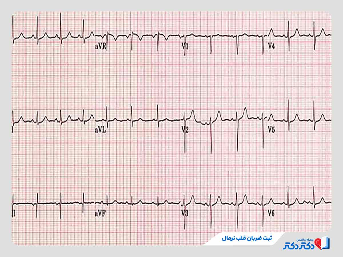 نتیجه تست نوار قلب نشان دهنده ریتم نرمال و منظم ضربان قلب 
