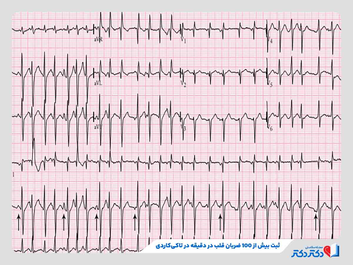 نتیجه تست نوار قلب نشاندهنده ابتلای فرد به تاکی‌کاردی
