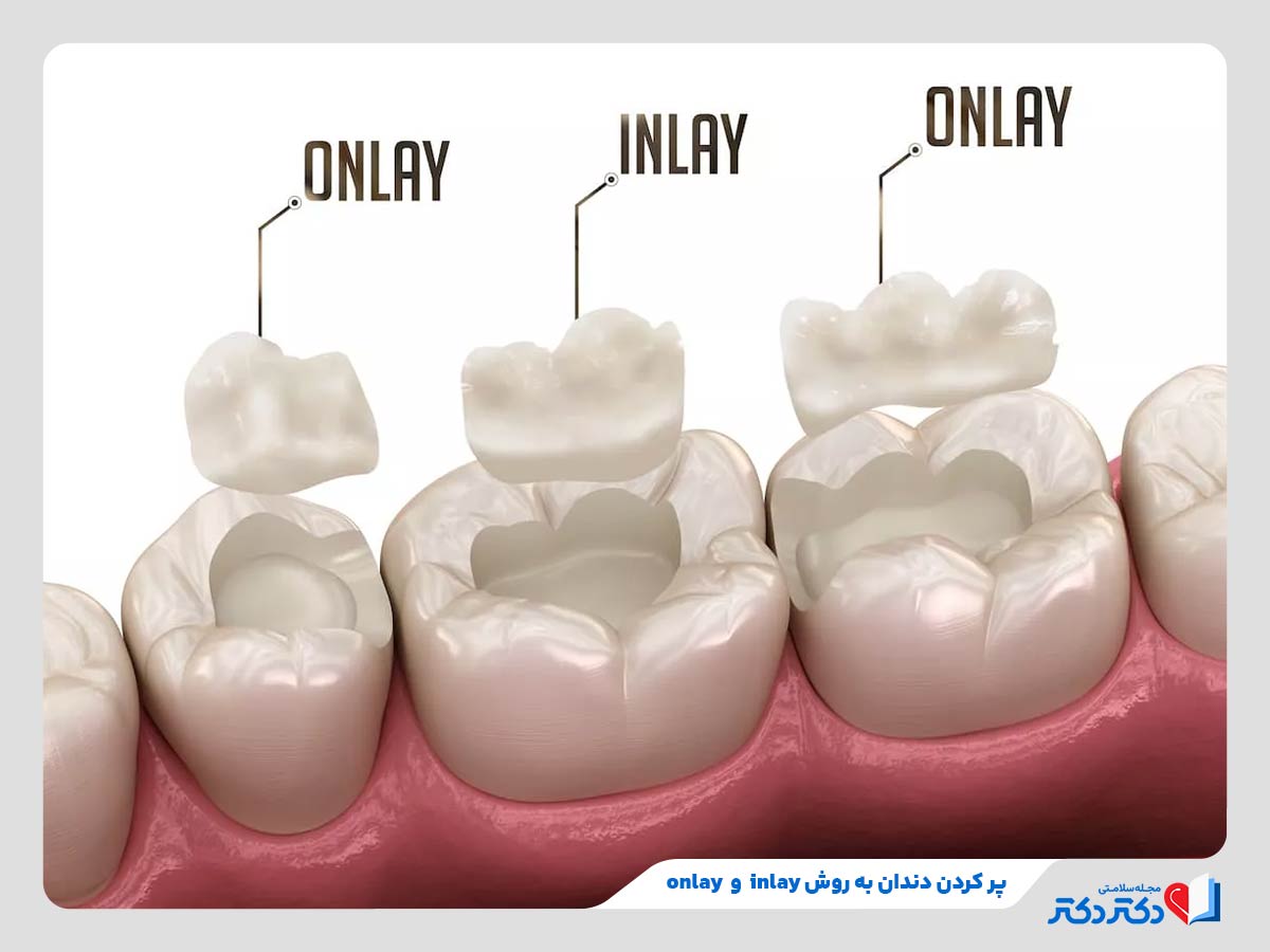 استفاده از روش‌های اینله و آنله برای پر کردن دندان