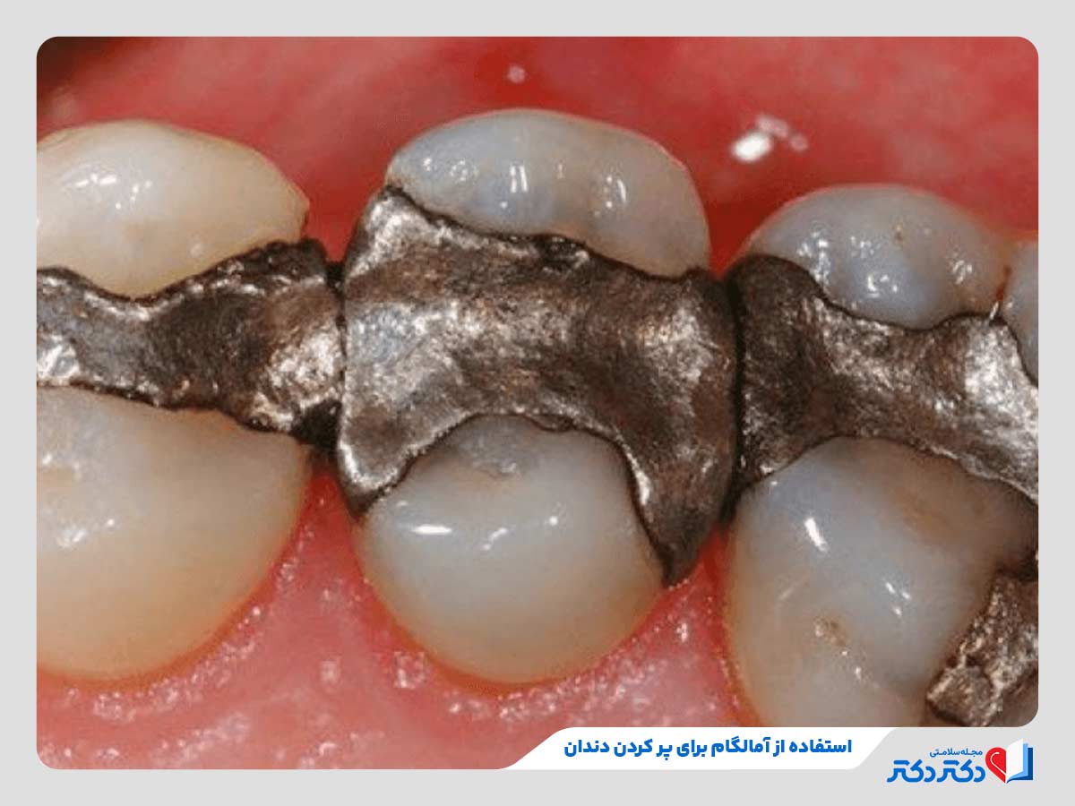 آمالگام؛ رایج‌ترین مواد برای پر کردن دندان