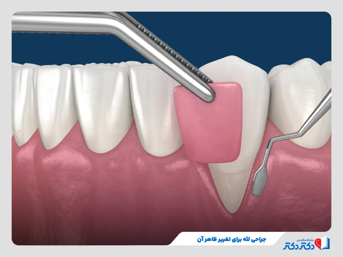 جراحی لثه برای تغییر ظاهر آن