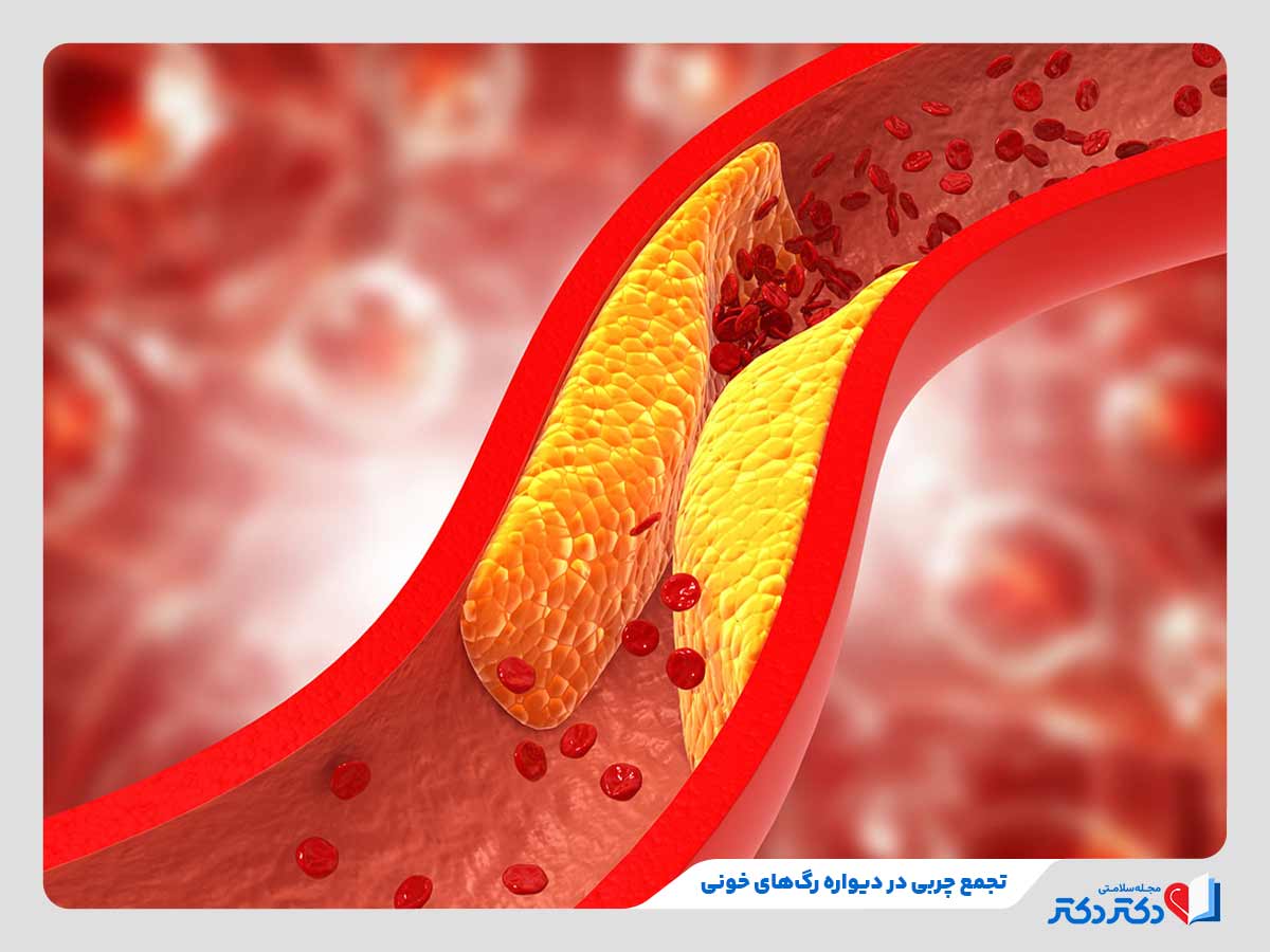 تصلب شراین از بدترین عوارض چربی خون بالا