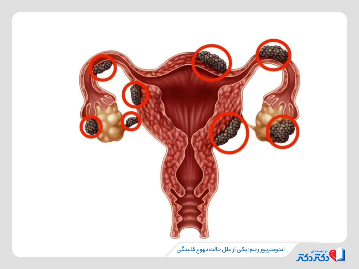 تصویر بافت اندومترویز روی نقاط مختلف رحم و اثر آن روی حالت تهوع قاعدگی