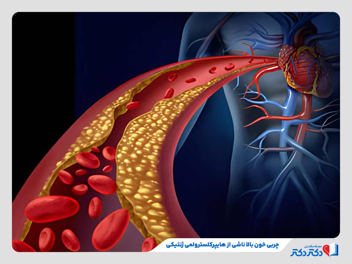 افزایش سطح کلسترول بد از کودکی در اثر اختلال ژنتیکی و ابتلا به چربی خون بالا