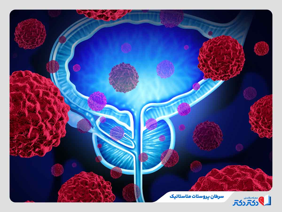انتشار سلول‌های سرطانی به اندام‌های دیگر و ابتلای فرد به سرطان پروستات متاستاتیک