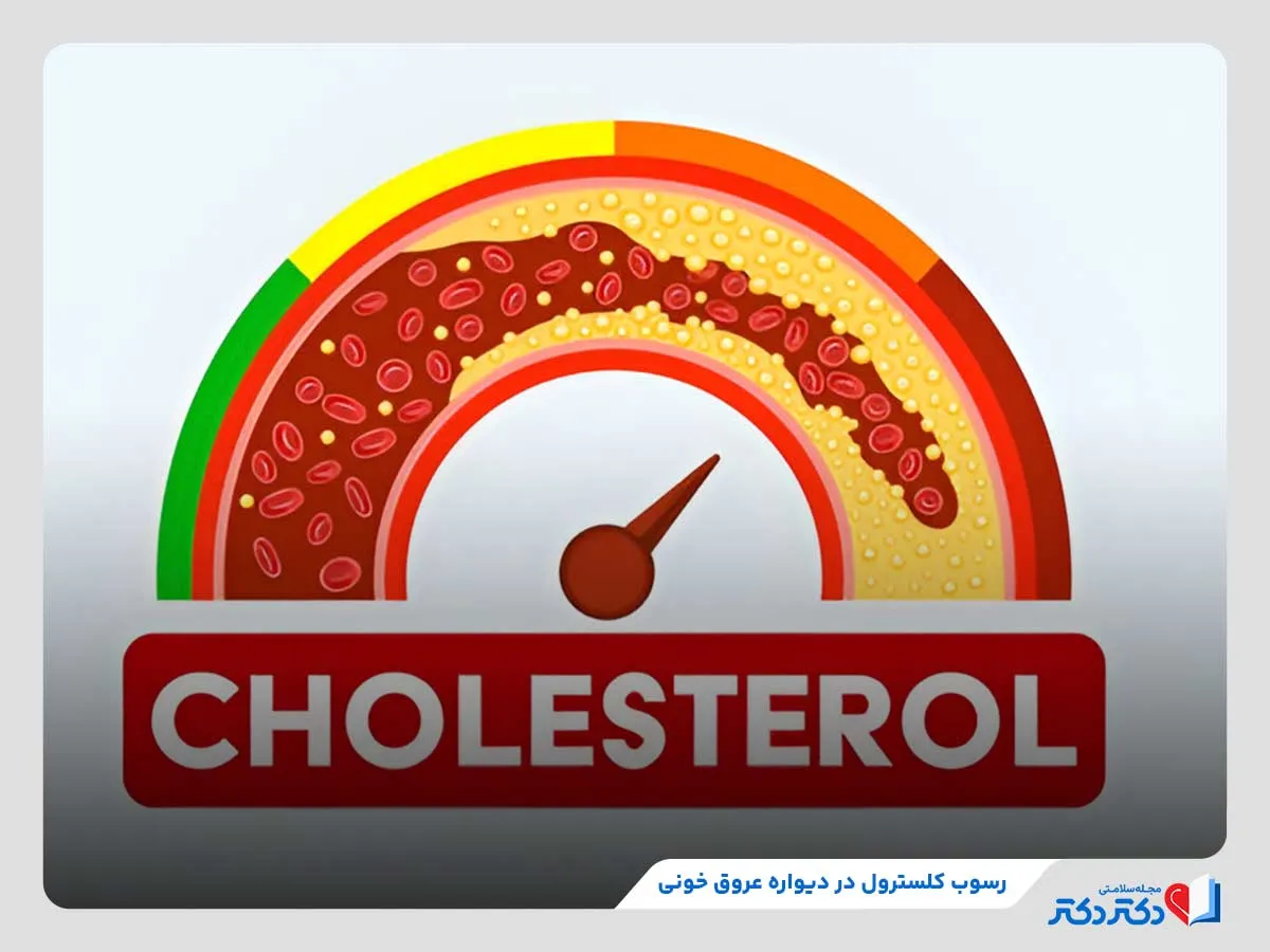 کلسترول، ماده‌ای از جنس چربی که در صورت افزایش مقدار در دیواره رگها رسوب می‌کند. 