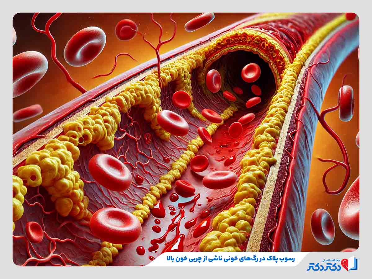 رسوب چربی‌ها در اثر افزایش کلسترول بد در بیماری چربی خون بالا