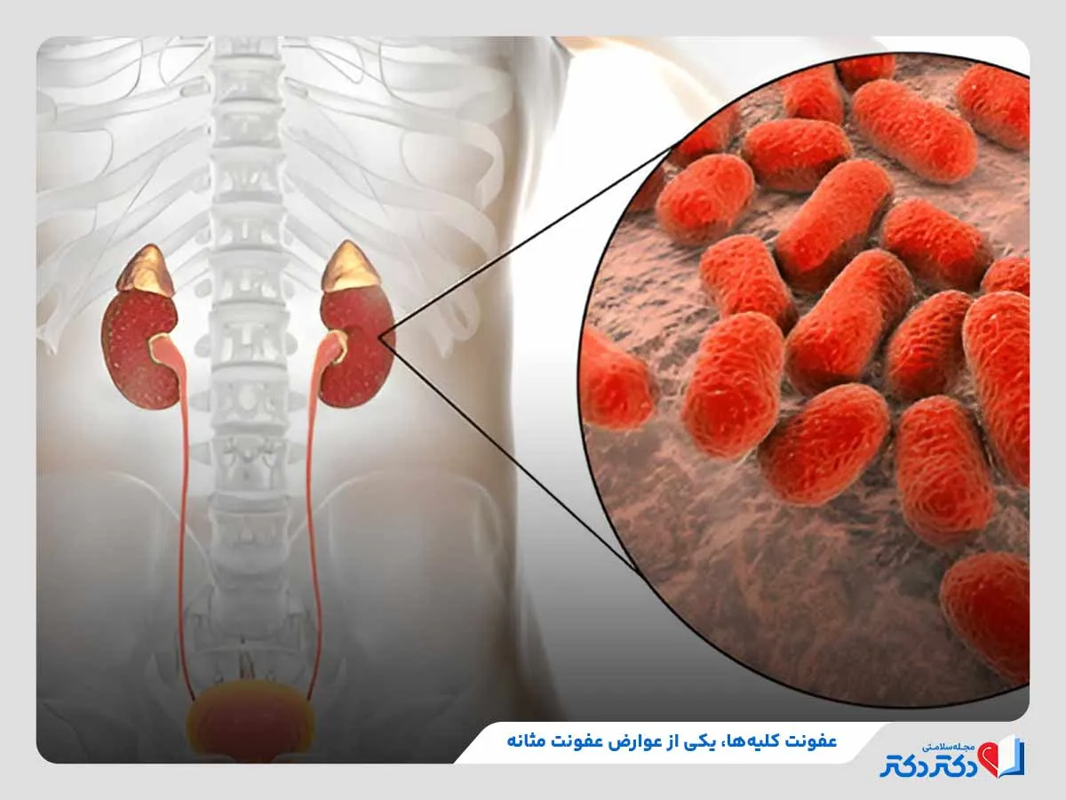 آسیب دائمی به کلیه‌ها و ایجاد عفونت، یکی از عوارض عفونت مثانه