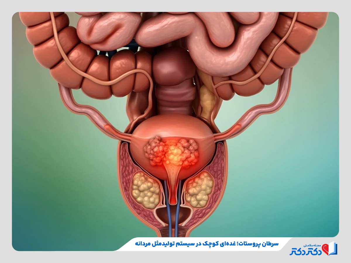 ابتلا به سرطان پروستات در سیستم تولید مثل مردانه