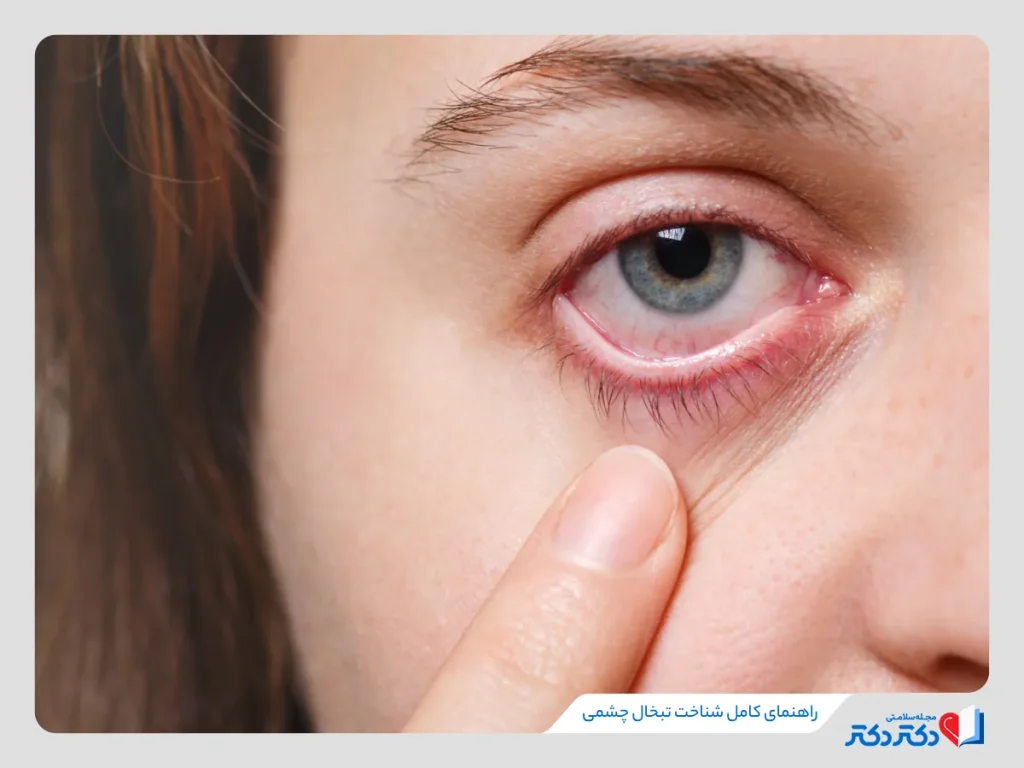 شناخت ویروس HSV و بیماری تبخال چشمی