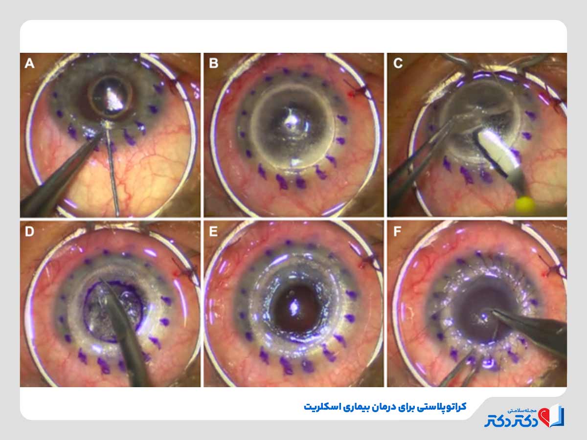 دکتر چشم در حال انجام کراتوپلاستی برای درمان بیمار مبتلا به بیماری اسکلریت