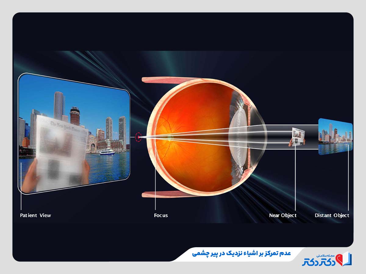 عدم تمرکز بر اشیا نزدیک و تار دیدن آن‌ها در افراد مبتلا به پیر چشمی