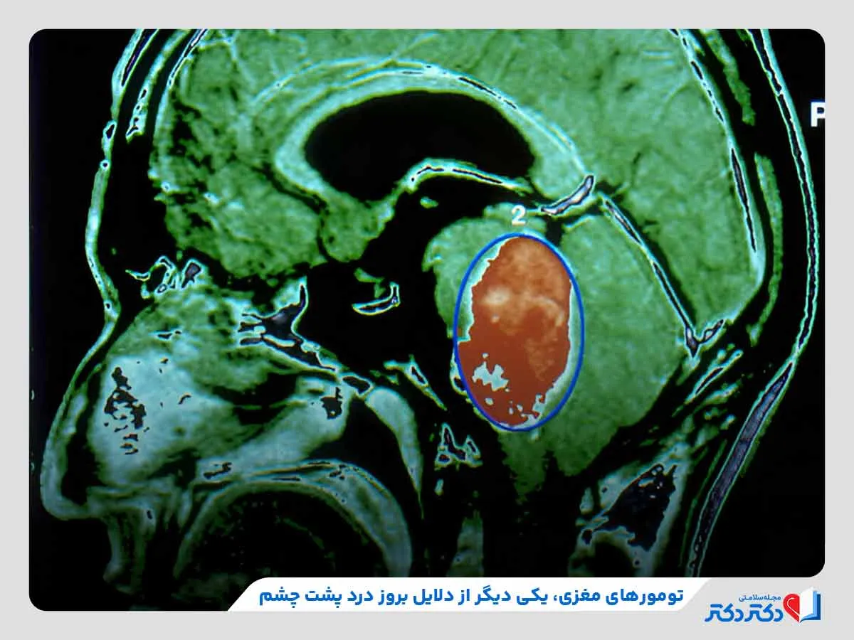 احساس درد در پشت چشم‌ها به دلیل وجود تومورهای مغزی