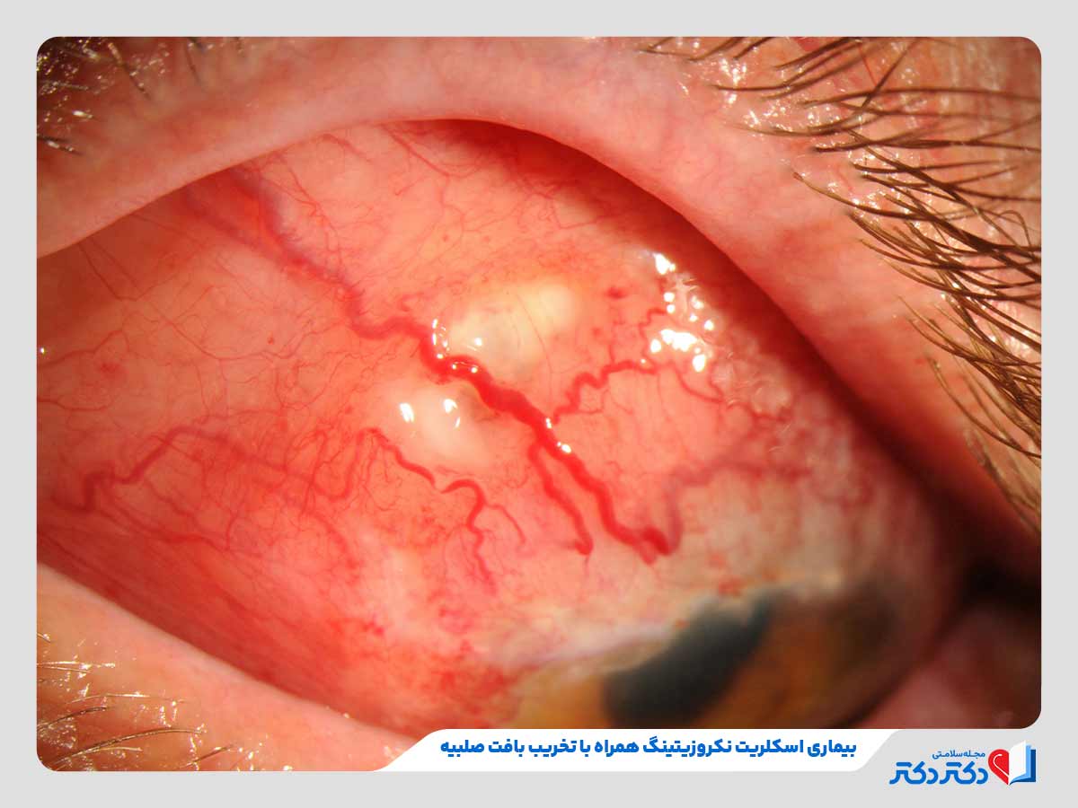 تحلیل بافت صلبیه چشم فرد در اثر ابتلا به بیماری اسکلریت