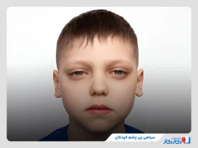 آیا سیاهی زیر چشم کودکان خطرناک است؟ بررسی دلایل و روشهای درمانی