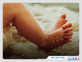 پوست ریزی نوزاد نشانه چیست و چطور درمان می‌شود؟