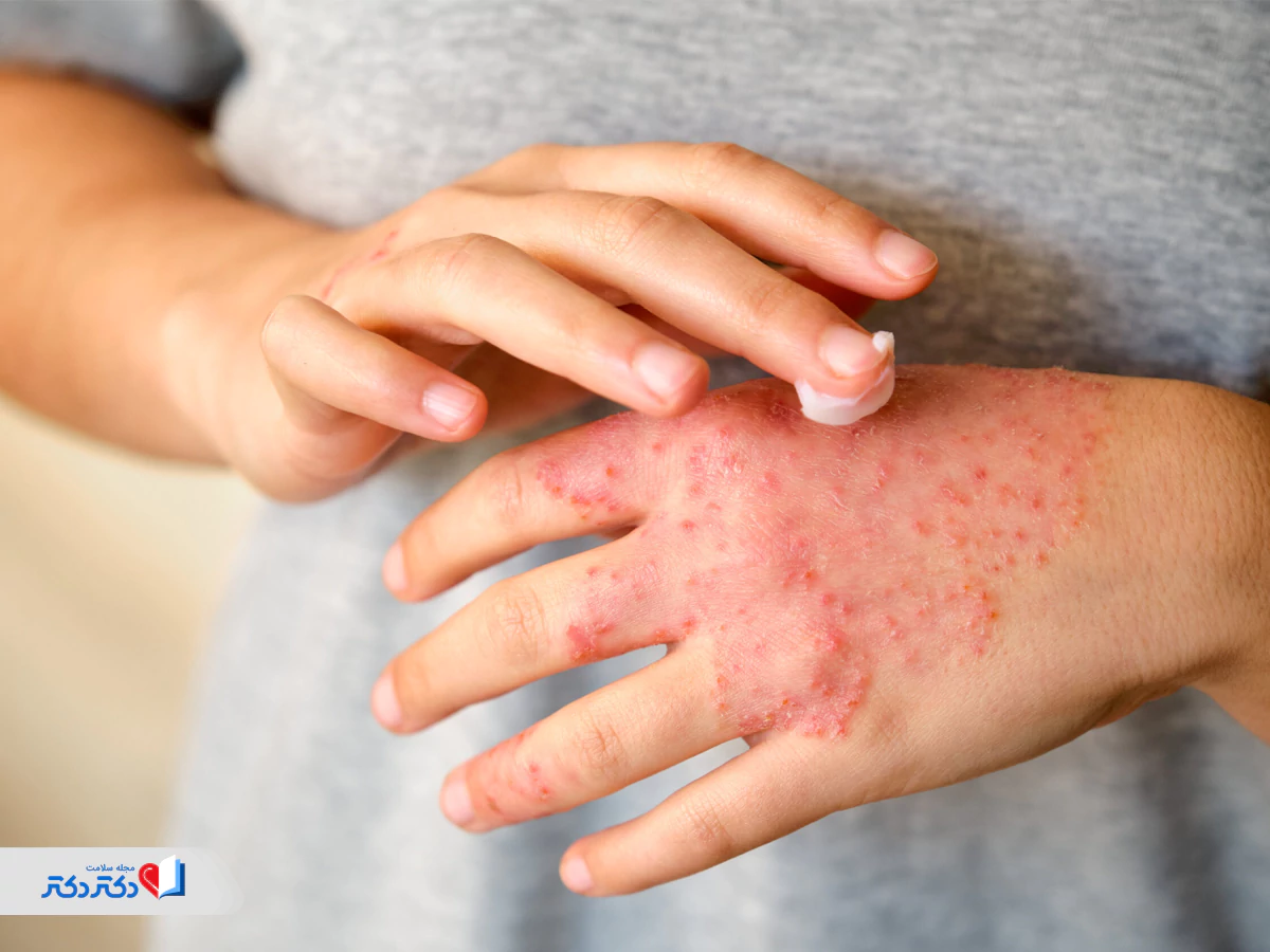 راش پوستی و خارش از عوارض پلارژین