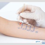 تست آلرژی چیست و در چه شرایطی باید انجام شود؟