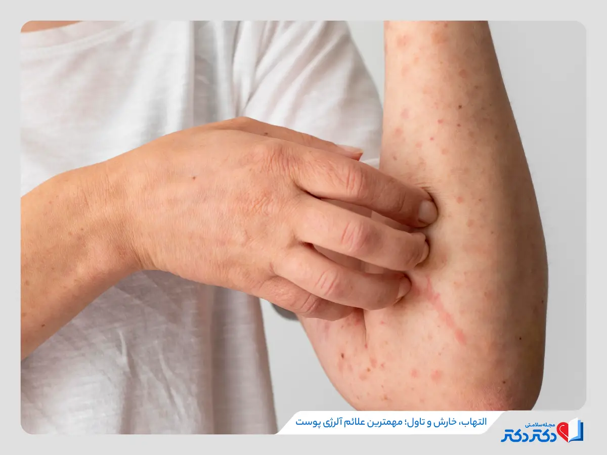 استفاده از پماد و قرص برای درمان آلرژی و حساسیت پوستی خفیف و متوسط مناسب است. 