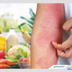 چرا به حساسیت غذایی مبتلا می‌شویم؟ معرفی علائم و راه‌های مدیریت آن