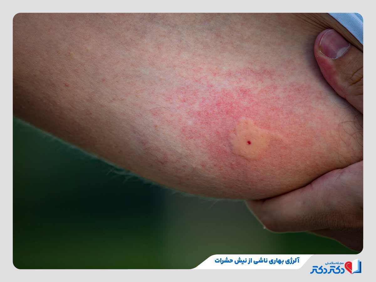 فرد مبتلا به گزیدگی زنبور به‌عنوان حساسیت فصلی بهار