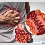 بیماری کرون چیست و چگونه می‌توان با آن مقابله کرد؟