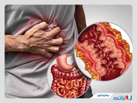 بیماری کرون چیست و چگونه میتوان با آن مقابله کرد؟