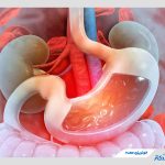 خونریزی معده چیست و چگونه درمان می‌شود؟ + روش‌های درمان و پیشگیری از آن