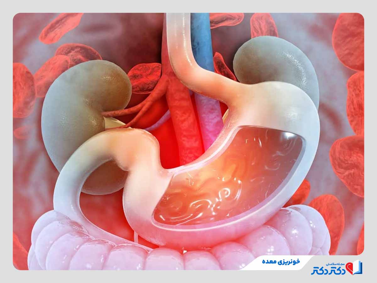 تصویر معده مبتلا به خونریزی معده