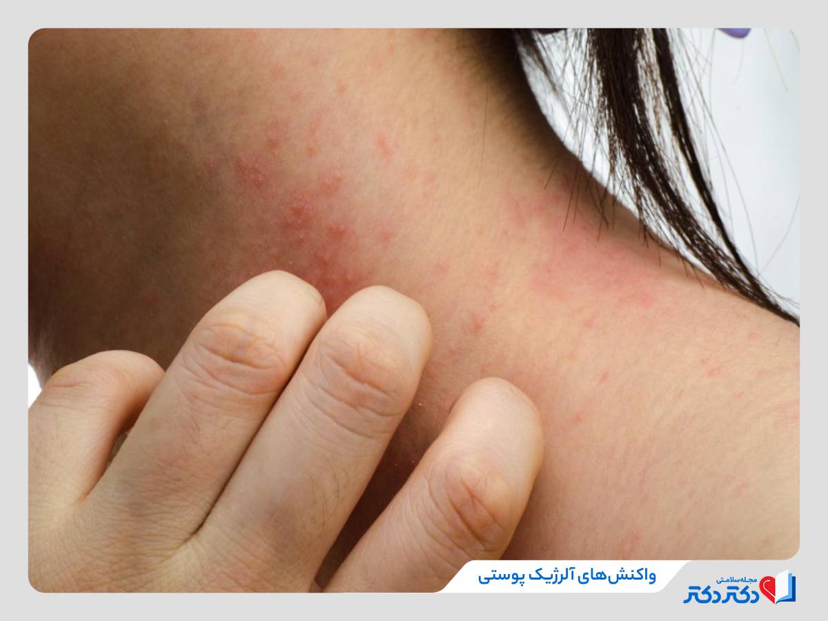 واکنش آلرژیک