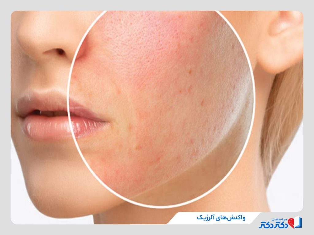 واکنش‌ های آلرژیک پوستی و مختلف